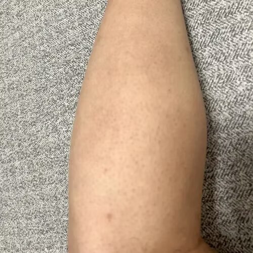 除毛のあと・照射前：すねの状態（店長・個人の記録）